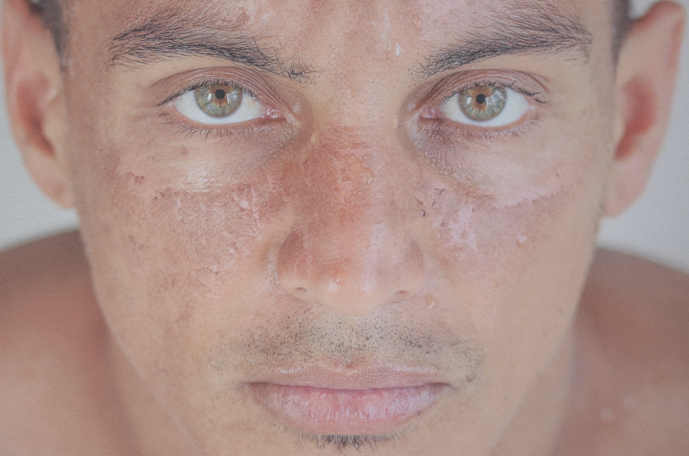 Photo of a figure’s face, with scar lines across his nose bridge and under his eyes, looking into the camera